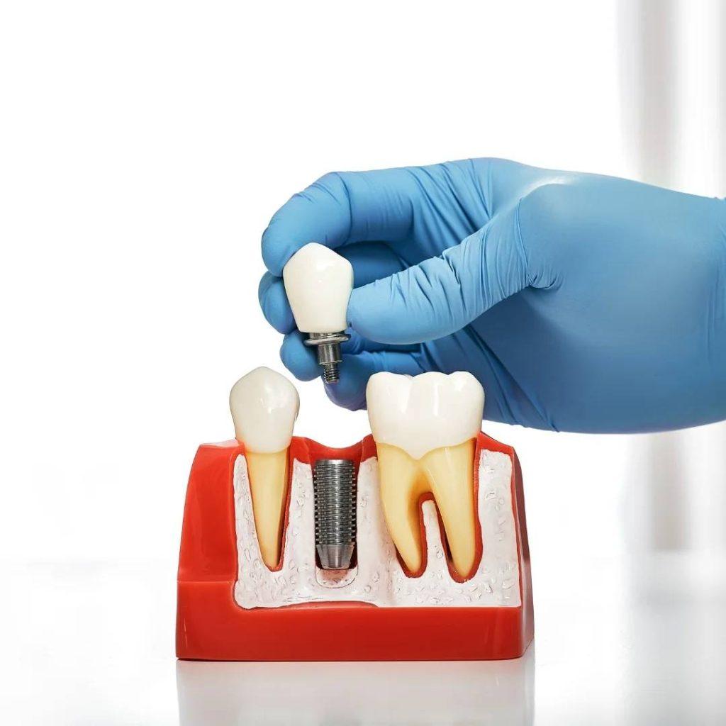 Restorative Dentistry in London, ON