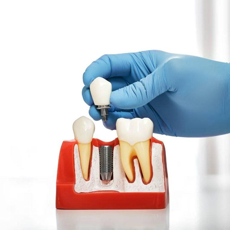 Restorative Dentistry in London, ON