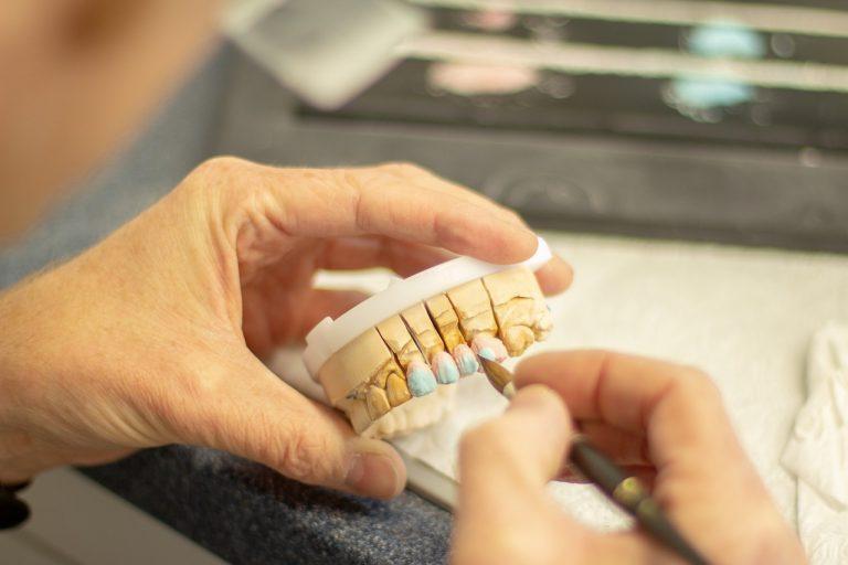 Technician's hand applies color detailing to dental model showing inlay restorations on tooth model arch